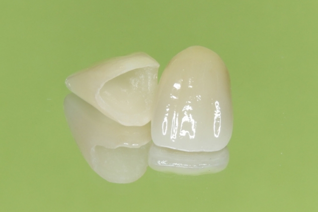 セラミック治療の費用